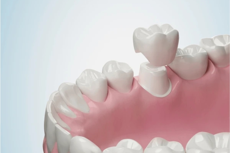 Dental Crowns