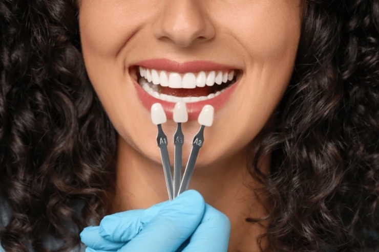 Dental Veneers