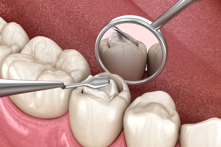 Dental Fillings
