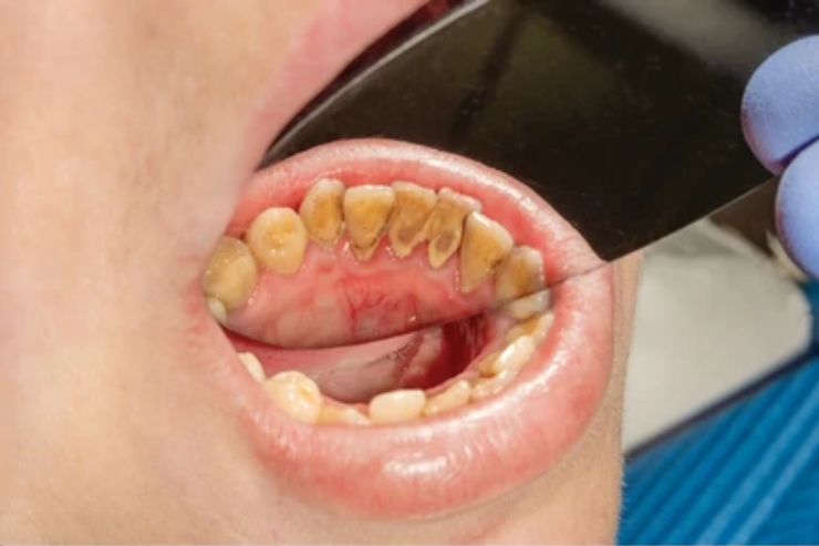 Oral Cancer Screening
