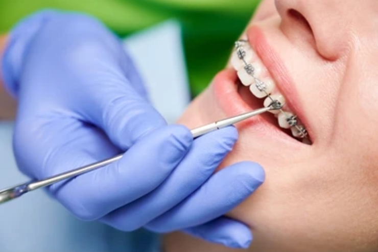 Orthodontic Treatments