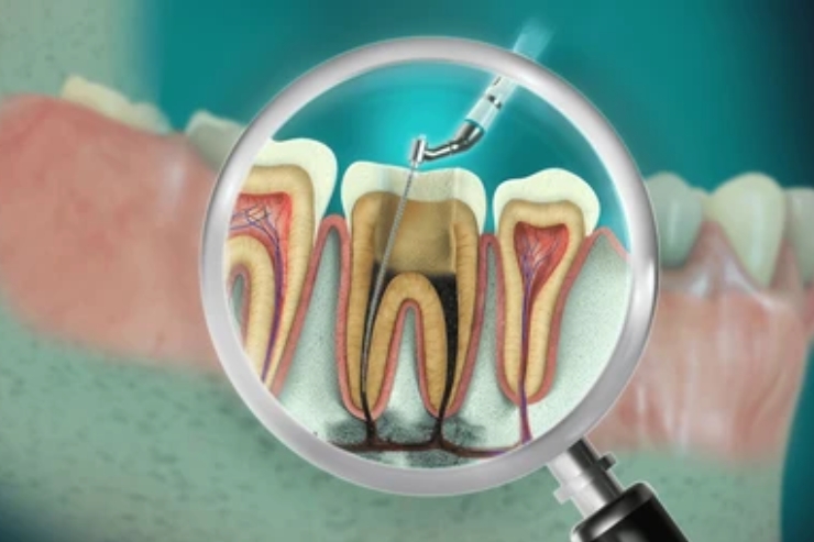 Root Canal Treatment (RCT)
